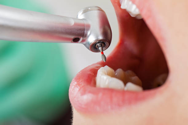 Best Knocked-Out Tooth (Avulsed Tooth) Treatment in Tompkinsville, KY